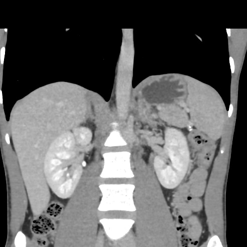 File:Chronic calcific pancreatitis (Radiopaedia 56280-62953 F 17).jpg