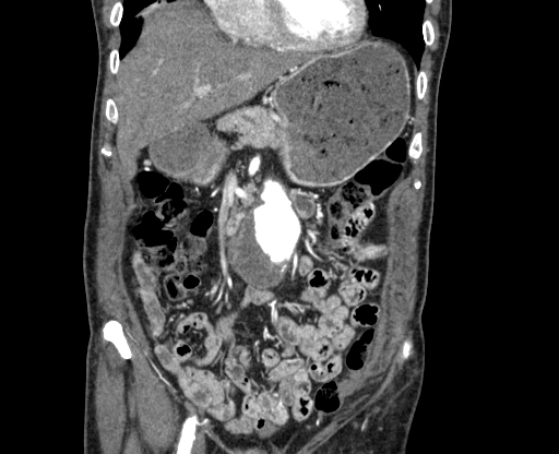 File:Chronic contained rupture of abdominal aortic aneurysm with extensive erosion of the vertebral bodies (Radiopaedia 55450-61901 D 14).jpg