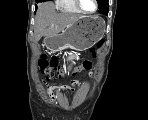 File:Chronic contained rupture of abdominal aortic aneurysm with extensive erosion of the vertebral bodies (Radiopaedia 55450-61901 D 5).jpg