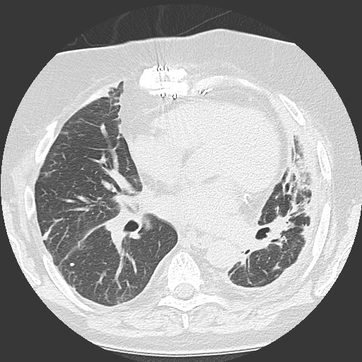 Chronic lung allograft dysfunction - restrictive form (Radiopaedia 60595-68316 Axial lung window 38).jpg