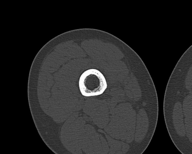 Chronic ostemyelitis of the femur with long sinus tract (Radiopaedia 74947-85982 Axial bone window 95).jpg