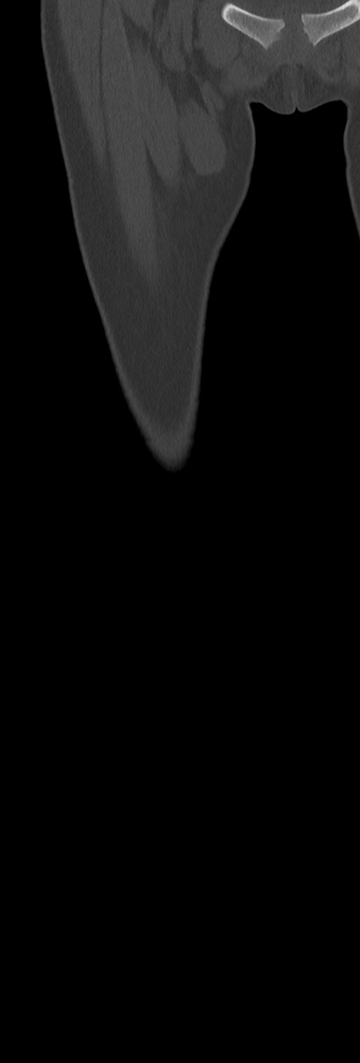 Chronic ostemyelitis of the femur with long sinus tract (Radiopaedia 74947-85982 Coronal bone window 15).jpg
