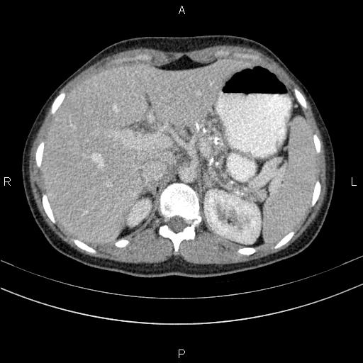 File:Chronic pancreatitis (Radiopaedia 64576-73450 C 33).jpg