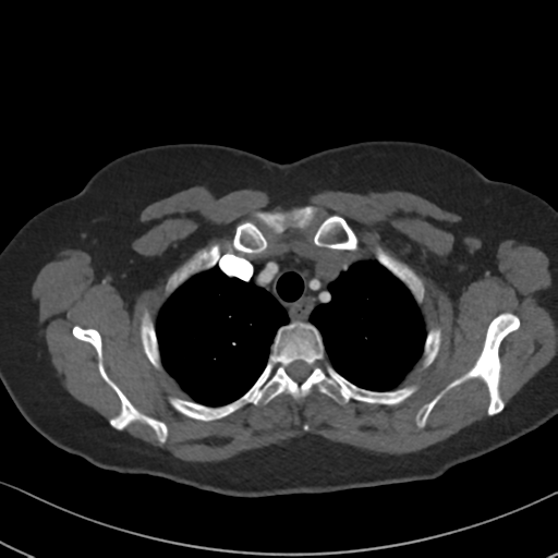 File:Chronic pulmonary embolus (Radiopaedia 39129-41341 Axial C+ CTPA 19).png
