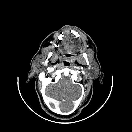File:Chronic submandibular abscess (Radiopaedia 21738-21718 A 9).jpg