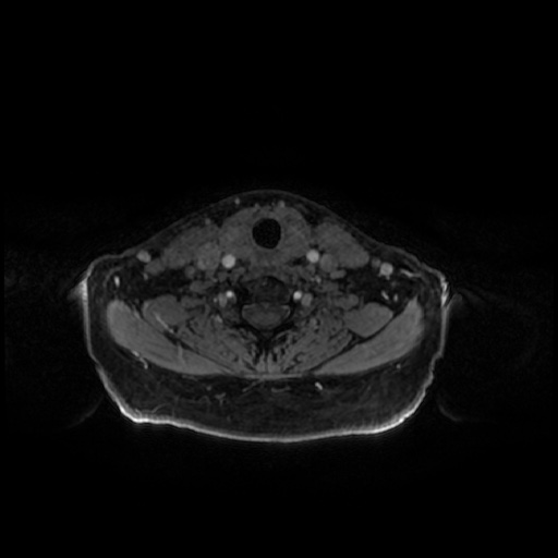 Chronic submandibular sialadenitis (Radiopaedia 61852-69885 Axial T1 C+ fat sat 8).jpg