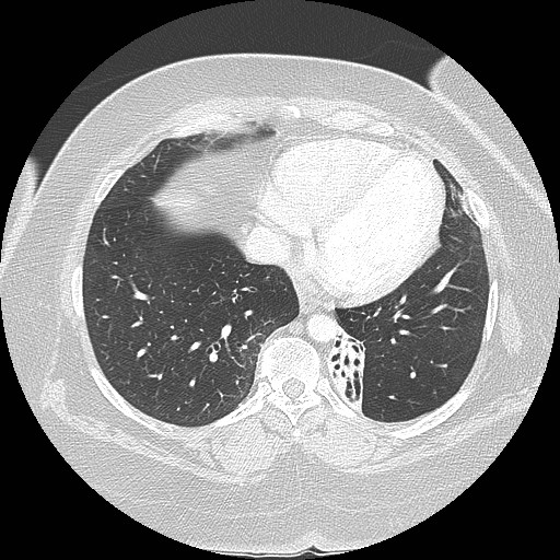 Cicatrisation collapse (Radiopaedia 17405-17089 lung window 77).jpg