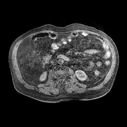 Cirrhosis and hepatocellular carcinoma in the setting of hemochromatosis (Radiopaedia 75394-86594 Axial T1 C+ fat sat 6).jpg