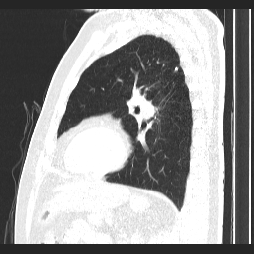 Classic complicated silicosis (Radiopaedia 49720-54961 Sagittal lung window 21).jpg