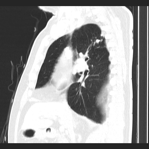 Classic complicated silicosis (Radiopaedia 49720-54961 Sagittal lung window 38).jpg