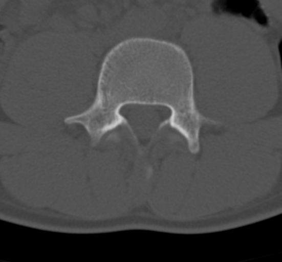 Clear cell meningoma - lumbar spine (Radiopaedia 60116-67691 Axial bone window 48).png