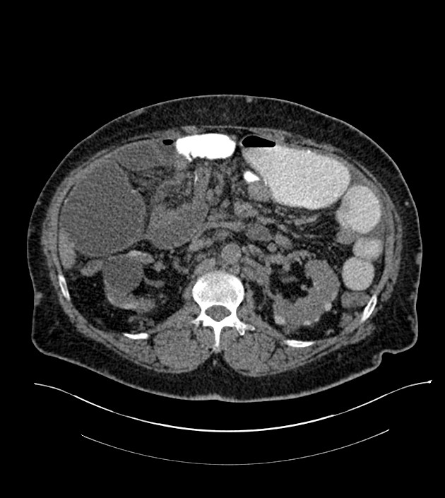 Closed-loop small bowel obstruction-internal hernia (Radiopaedia 78439-91096 Axial non-contrast 64).jpg