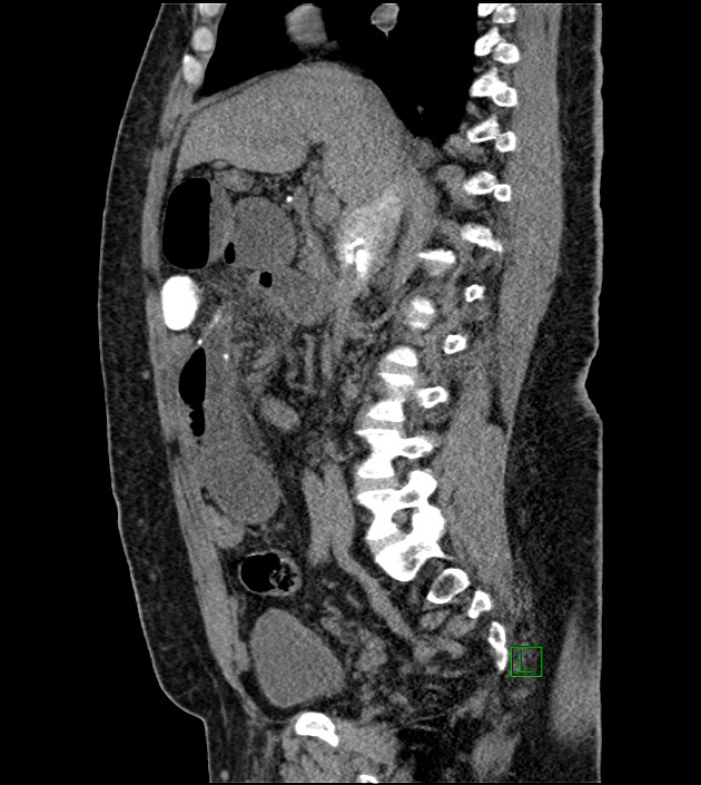 Closed-loop small bowel obstruction-internal hernia (Radiopaedia 78439-91096 C 85).jpg
