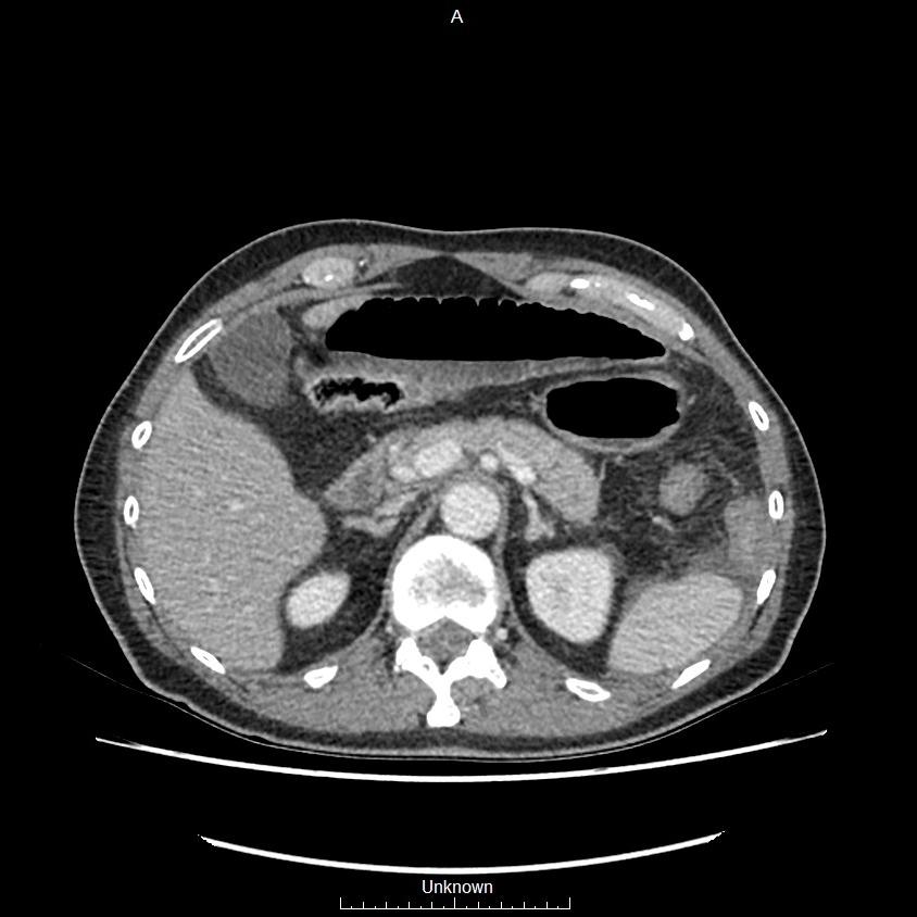 Closed loop bowel obstruction and ischemia (Radiopaedia 86959-103180 A 17).jpg