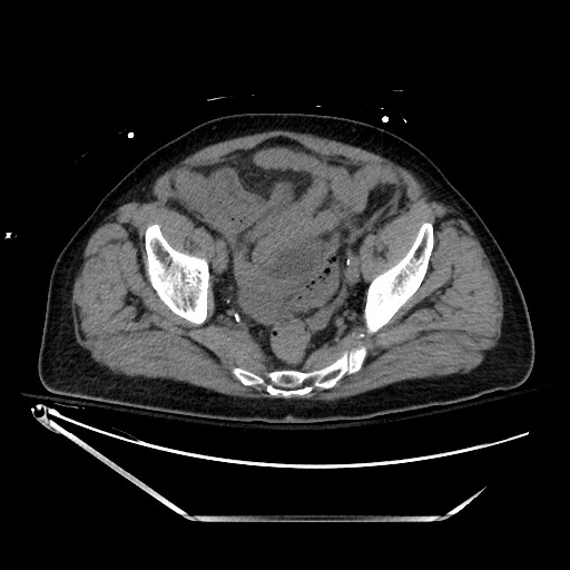 Closed loop obstruction due to adhesive band, resulting in small bowel ischemia and resection (Radiopaedia 83835-99023 Axial non-contrast 130).jpg