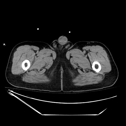 File:Closed loop obstruction due to adhesive band, resulting in small bowel ischemia and resection (Radiopaedia 83835-99023 Axial non-contrast 184).jpg