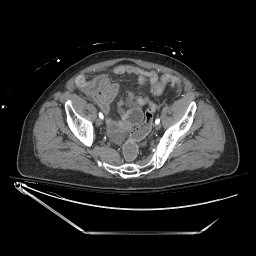 Closed loop obstruction due to adhesive band, resulting in small bowel ischemia and resection (Radiopaedia 83835-99023 B 127).jpg