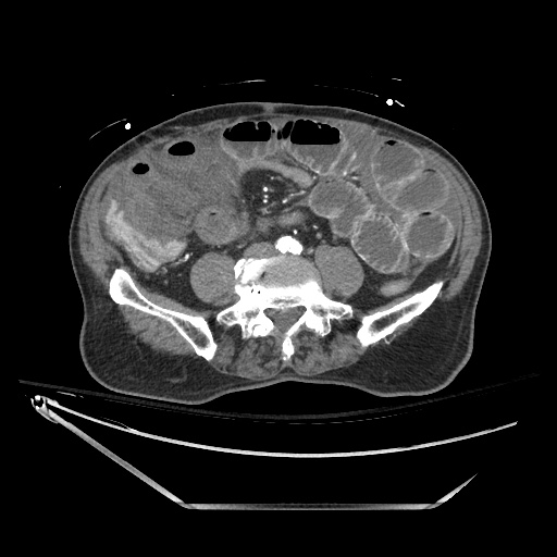 File:Closed loop obstruction due to adhesive band, resulting in small bowel ischemia and resection (Radiopaedia 83835-99023 B 96).jpg