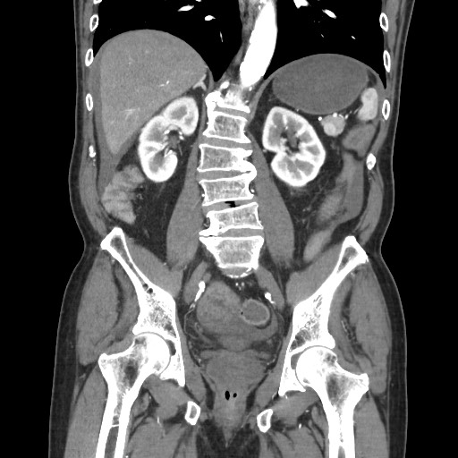 File:Closed loop obstruction due to adhesive band, resulting in small bowel ischemia and resection (Radiopaedia 83835-99023 C 79).jpg