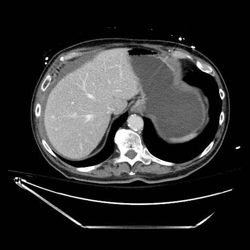 File:Closed loop obstruction due to adhesive band, resulting in small bowel ischemia and resection (Radiopaedia 83835-99023 D 32).jpg