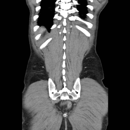 File:Closed loop small bowel obstruction (Radiopaedia 59227-66554 B 44).jpg