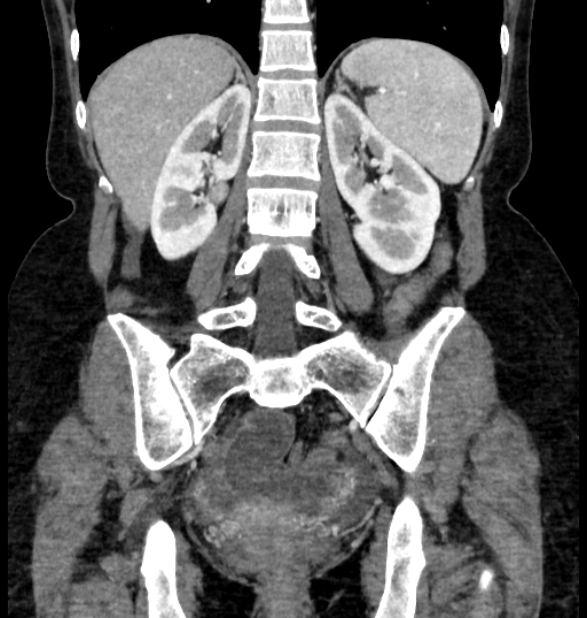 Closed loop small bowel obstruction (Radiopaedia 71211-81508 B 88).jpg
