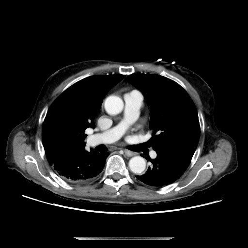 File:Closed loop small bowel obstruction - adhesive disease and hemorrhagic ischemia (Radiopaedia 86831-102990 A 2).jpg