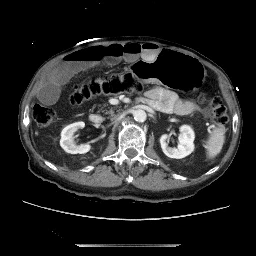 Closed loop small bowel obstruction - adhesive disease and hemorrhagic ischemia (Radiopaedia 86831-102990 A 81).jpg
