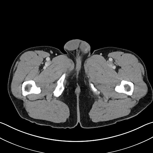 Closed loop small bowel obstruction - internal hernia (Radiopaedia 57806-64778 B 144).jpg