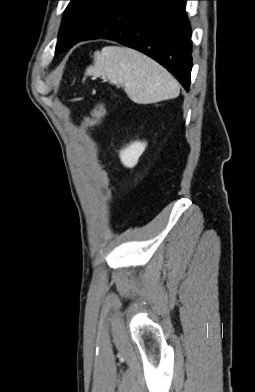 Closed loop small bowel obstruction - internal hernia (Radiopaedia 57806-64778 C 21).jpg