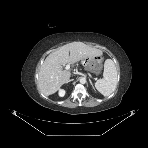 Closed loop small bowel obstruction - internal hernia (Radiopaedia 65402-74450 A 29).jpg