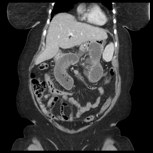 Closed loop small bowel obstruction - internal hernia (Radiopaedia 65402-74450 B 35).jpg