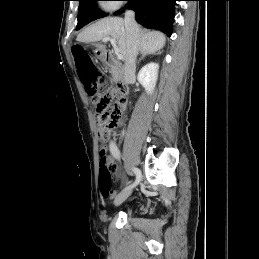 File:Closed loop small bowel obstruction - omental adhesion causing "internal hernia" (Radiopaedia 85129-100682 C 74).jpg