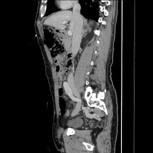 File:Closed loop small bowel obstruction - omental adhesion causing "internal hernia" (Radiopaedia 85129-100682 C 78).jpg