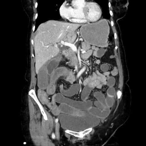 Closed loop small bowel obstruction due to adhesive band, with intramural hemorrhage and ischemia (Radiopaedia 83831-99017 C 49).jpg