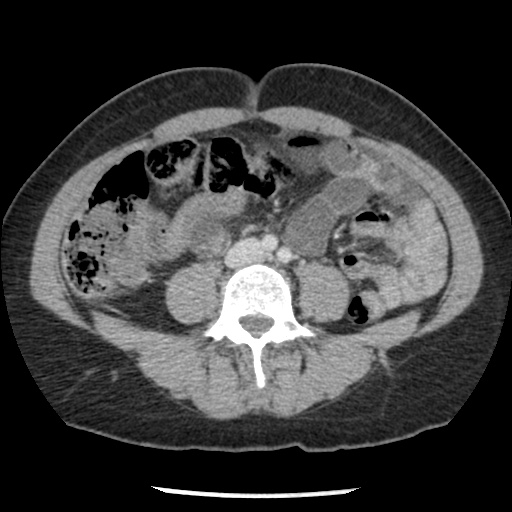 Closed loop small bowel obstruction due to trans-omental herniation (Radiopaedia 35593-37109 A 51).jpg