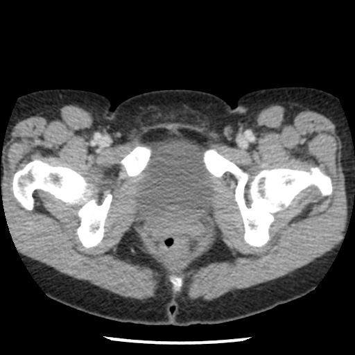 Closed loop small bowel obstruction due to trans-omental herniation (Radiopaedia 35593-37109 A 85).jpg
