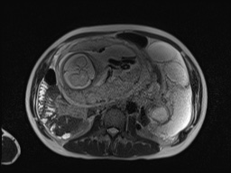 File:Closed loop small bowel obstruction in pregnancy (MRI) (Radiopaedia 87637-104031 Axial T2 36).jpg