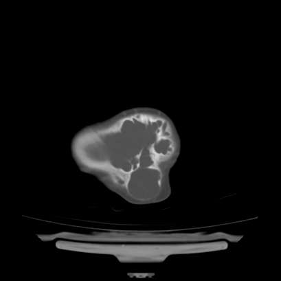 Cloverleaf skull (Radiopaedia 91901-109710 Axial bone window 135).jpg