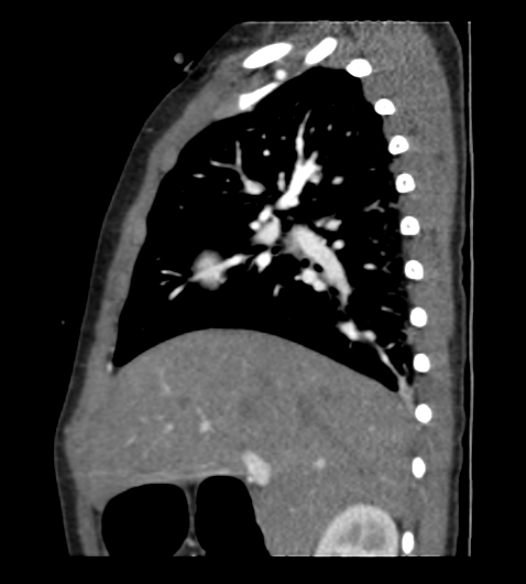 Coarctation of aorta (Radiopaedia 27427-27622 Sagittal C+ CTPA 30).png
