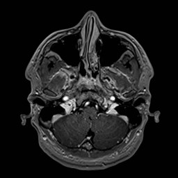 Cochlear incomplete partition type III associated with hypothalamic hamartoma (Radiopaedia 88756-105498 Axial T1 C+ 44).jpg