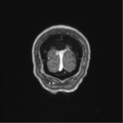 Colloid cyst of the third ventricle (Radiopaedia 86571-102662 Coronal T1 C+ 7).png