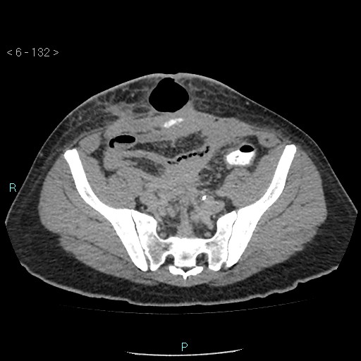 Colo-cutaneous fistula (Radiopaedia 40531-43129 A 55).jpg