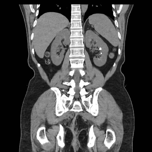 File:Colocutaneous fistula in Crohn's disease (Radiopaedia 29586-30093 Coronal non-contrast 31).jpg