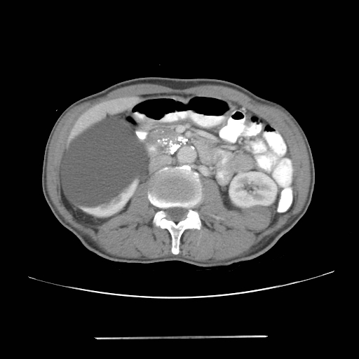 Colon cancer with calcified liver metastasis (Radiopaedia 74423-85307 A 33).jpg