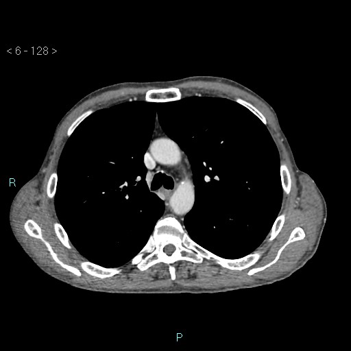 Colonic cancer (ultrasound and TC imaging) (Radiopaedia 50346-55713 B 128).jpg