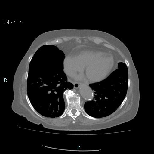 Colonic lipomas (Radiopaedia 49137-54244 Axial bone window 19).jpg