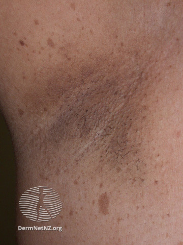 File:Freckling in the armpit (DermNet NZ systemic-nf3).jpg