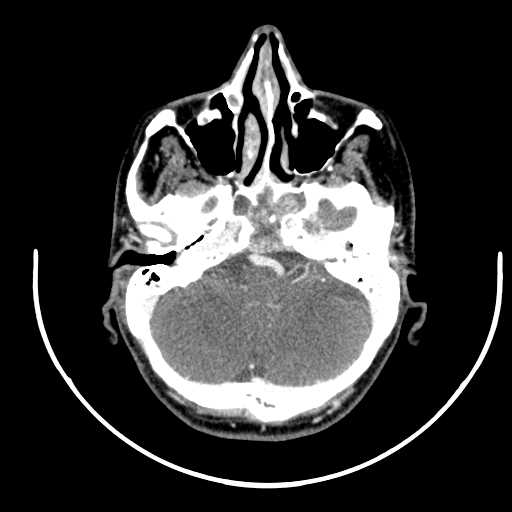 File:Nasopharyngeal carcinoma - infiltrating the clivus (Radiopaedia 62583-70875 Axial Post contrast 10).jpg