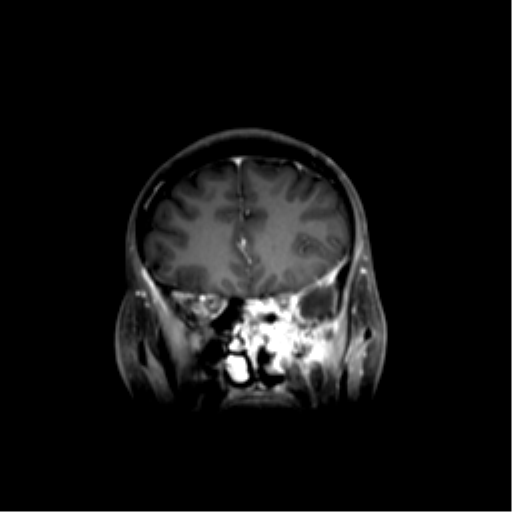 File:Nasopharyngeal carcinoma with cerebral abscess (Radiopaedia 43018-46274 L 18).png